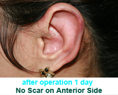 plastic-surgery-prominent-ear 